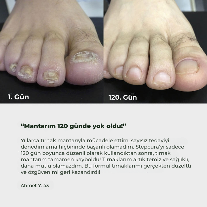 Stepcura Tırnak Mantarı Tedavi Jeli